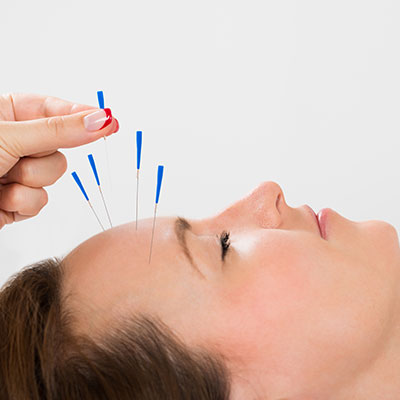 Acupuncture